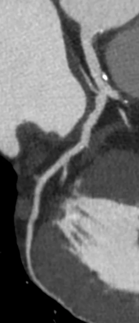 Herz-CT, cMPR-Längsschnitt eines Herzkranzgefäßes mit gemischten – verkalkten und weichen – Plaques.